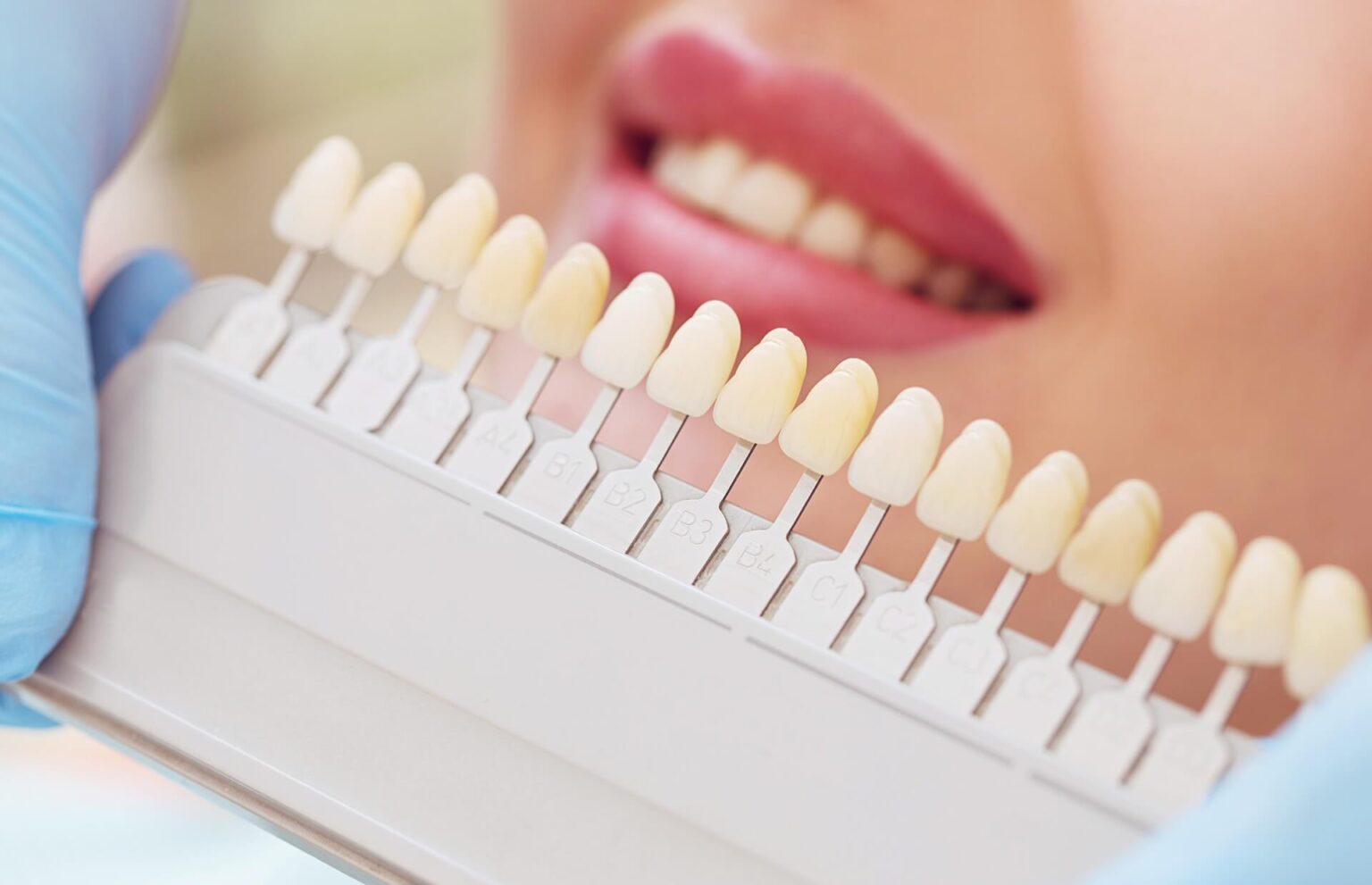 Teeth Whitening in Cardiff: Guide to a Brighter Smile
